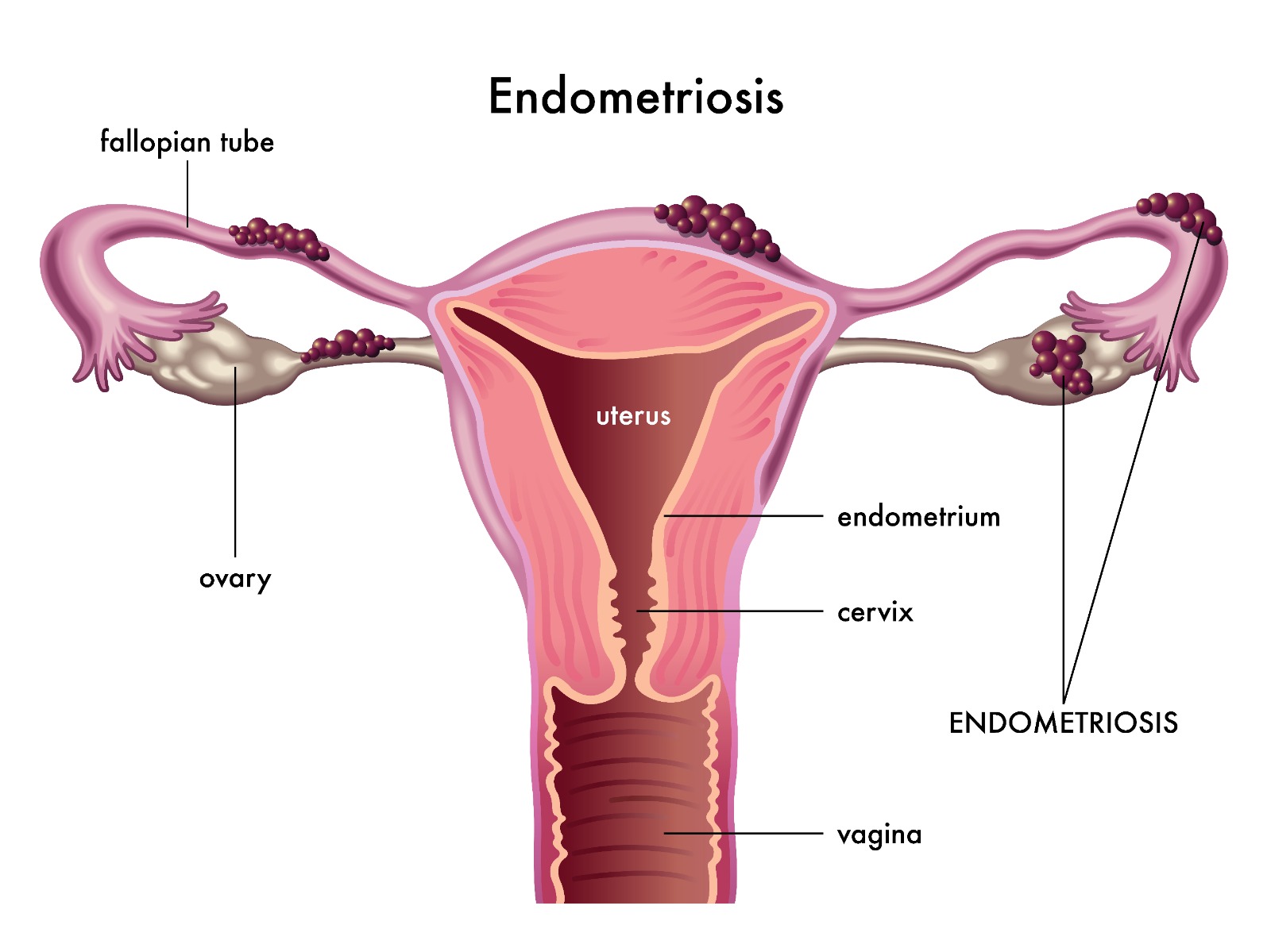 Understanding Endometriosis Causes Symptoms And Treatment understanding-endometriosis-causes-symptoms-and-treatment